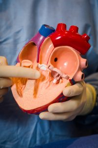 Image about heart procedure